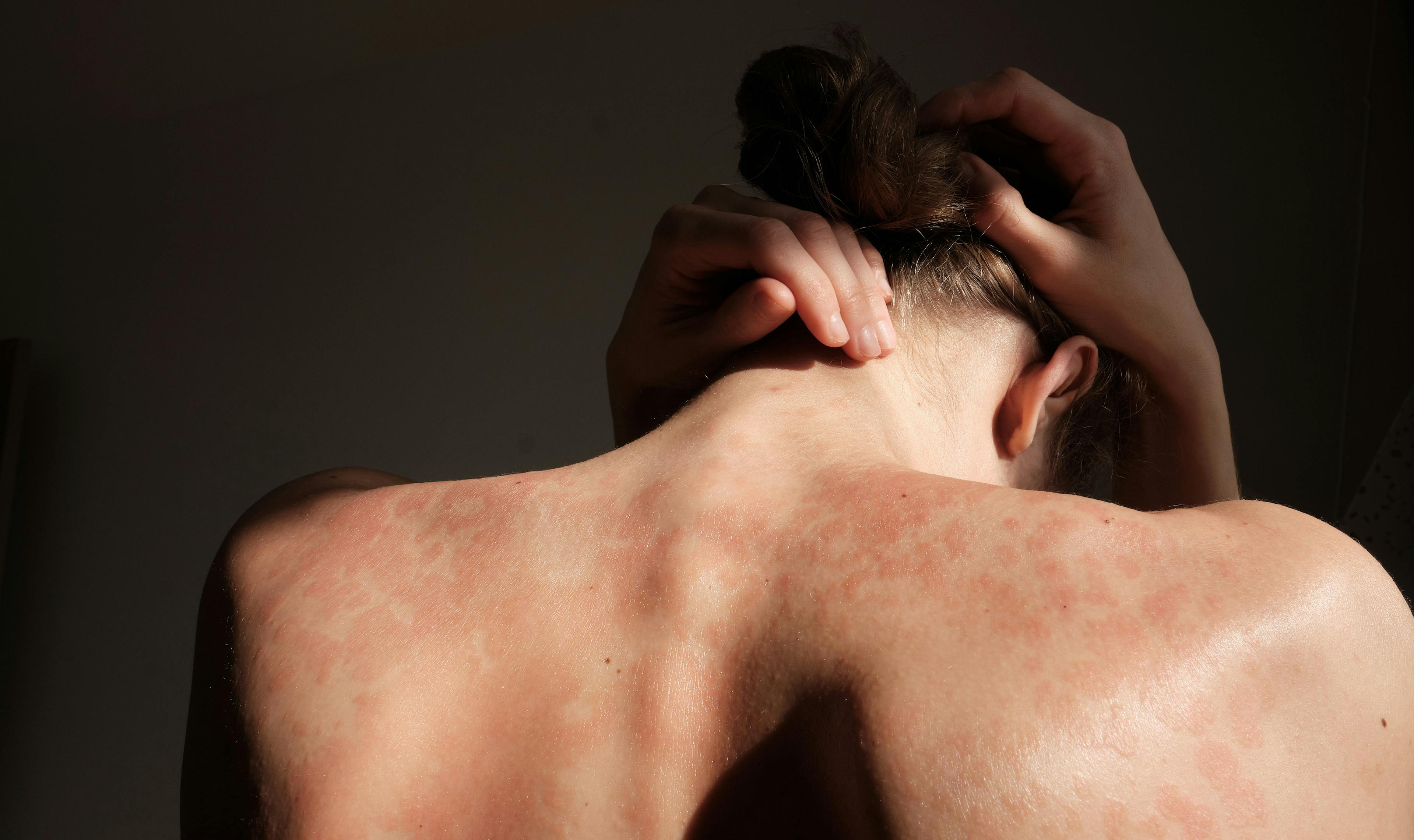 Close-up woman touches herself. Neck, back, spine. Psoriasis skin, eczema, rash and other skin diseases. A woman hides her face, she is ashamed of her autoimmune genetic disease - Image credit: stockmaster | stock.adobe.com