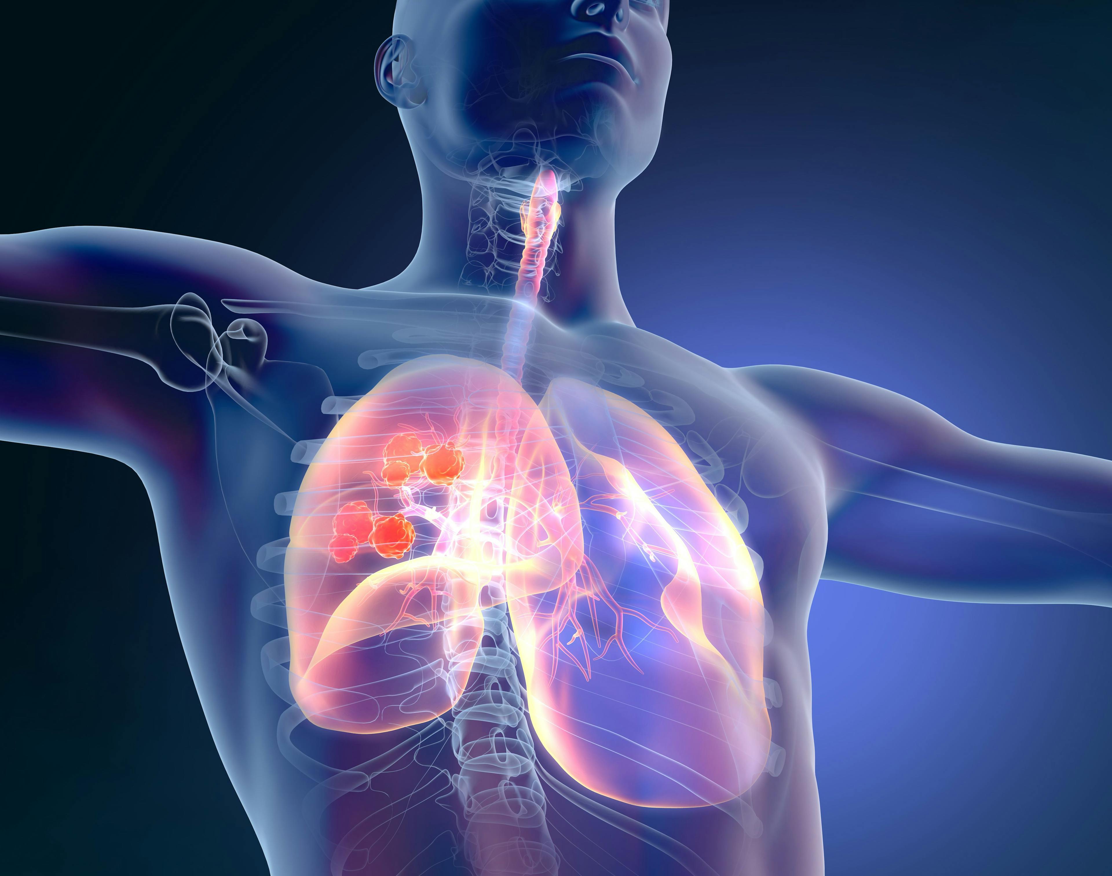Nivolumab, Chemotherapy Improves Event-Free Survival in Resectable Non-Small Cell Lung Cancer