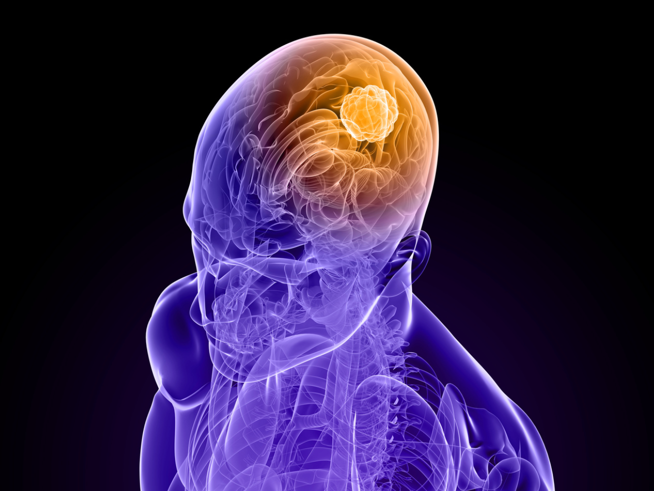 Recurrent Glioblastoma Brain Tumors With Fewer Mutations Respond Better to Immunotherapy