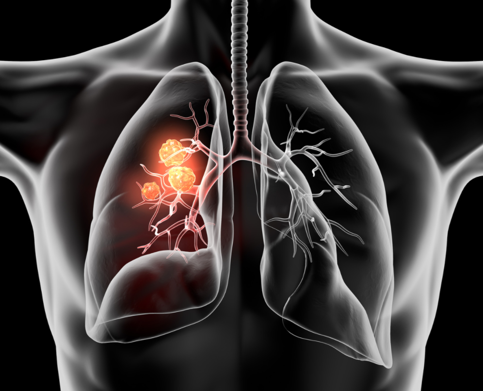 Domvanalimab Combination Shows Clinically Meaningful Progression-Free Survival in Lung Cancer 