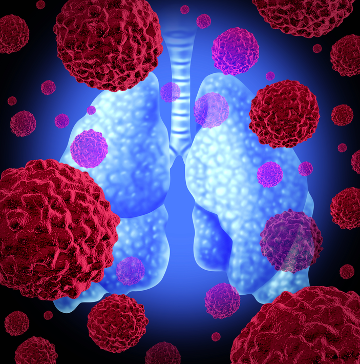 No Significant Signal in Adverse Events in Phase 3 Trial Assessing Nivolumab Plus Platinum-Doublet Chemotherapy for Resectable Non-Small Cell Lung Cancer