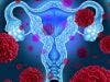 FDA Approves Advanced Ovarian Cancer Treatment