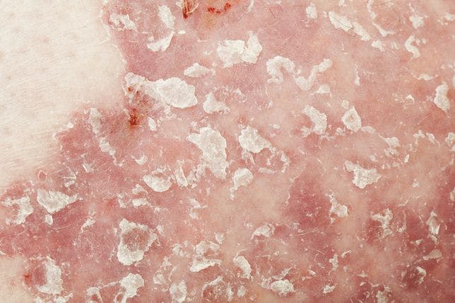 New Treatment for Plaque Psoriasis Approved in Europe