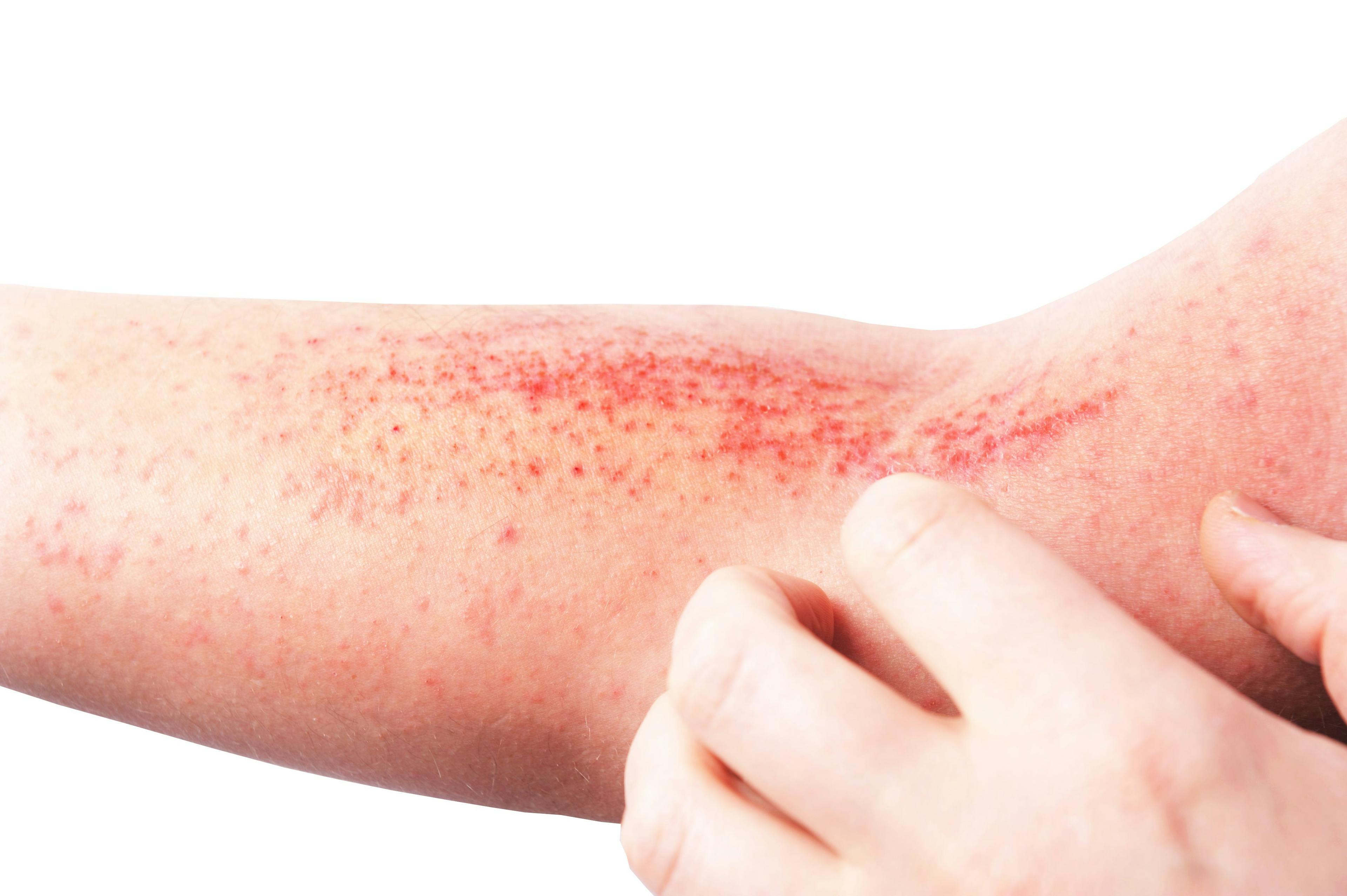 Atopic dermatitis (AD), also known as atopic eczema, is a type of inflammation of the skin (dermatitis) | Image Credit: lial88 - stock.adobe.com