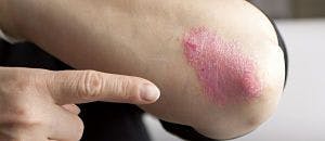 Brodalumab Application Under Review for Plaque Psoriasis