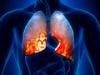 Combination of Atezolizumab, Bevacizumab Improves Lung Cancer Survival