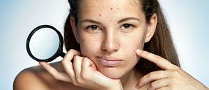 Once-Daily Aczone Approved to Treat Acne