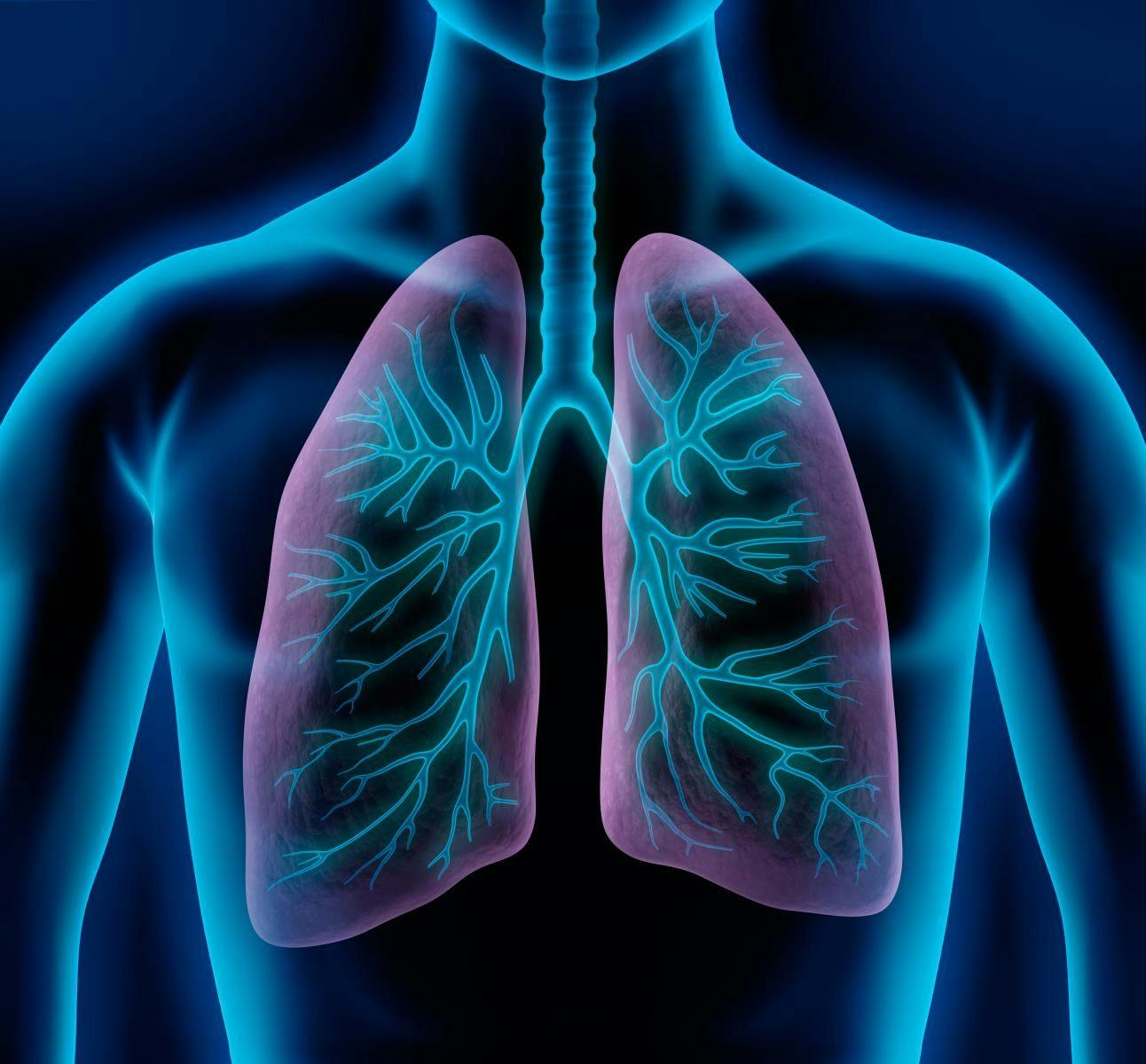 Three-Drug Combo Improves Lung Function in Patients with Cystic Fibrosis