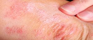 Study: Patients with COVID-19 Experience Lasting Skin Problems