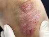 Ustekinumab Shows Promise in Severe Atopic Dermatitis