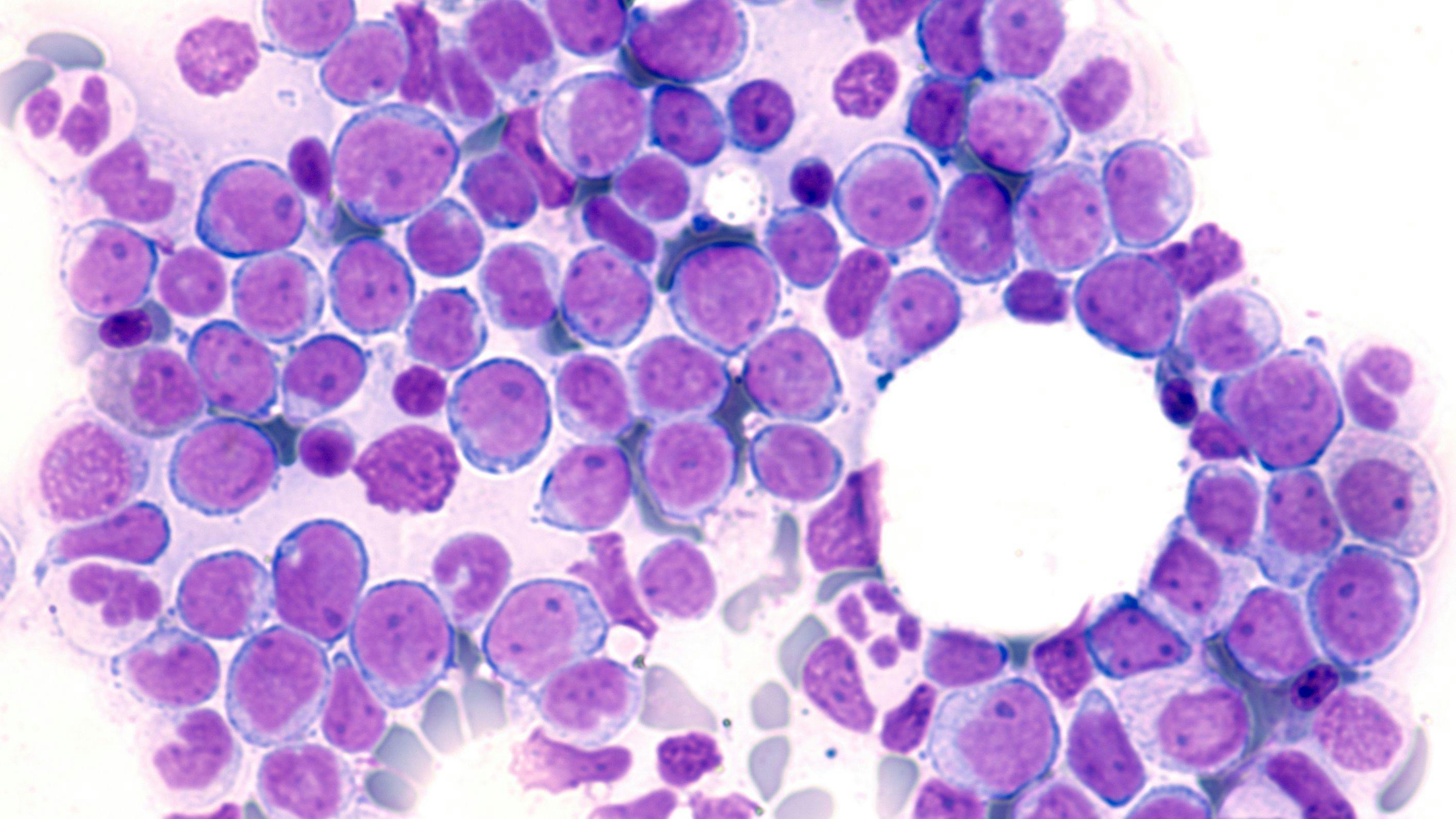 Acute myeloid leukemia -- Image credit: David A Litman | stock.adobe.com 
