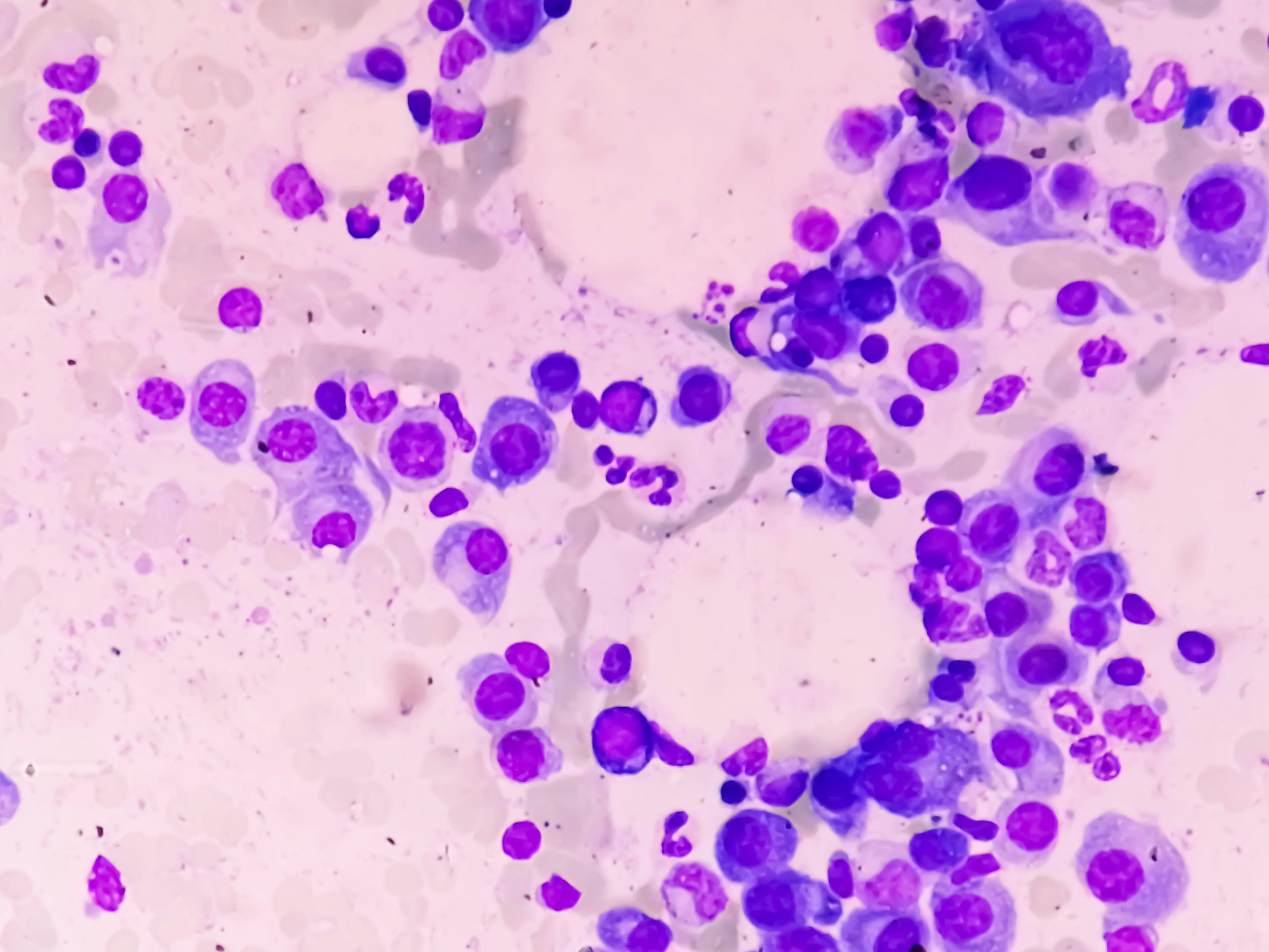 Microscopic view of bone marrow with multiple myeloma