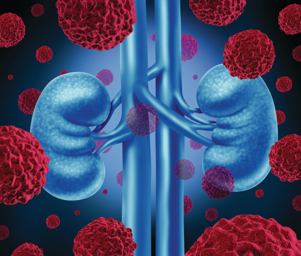 Study: Four Treatment Options for Renal Cell Carcinoma Prove More Effective Than Sunitinib Monotherapy
