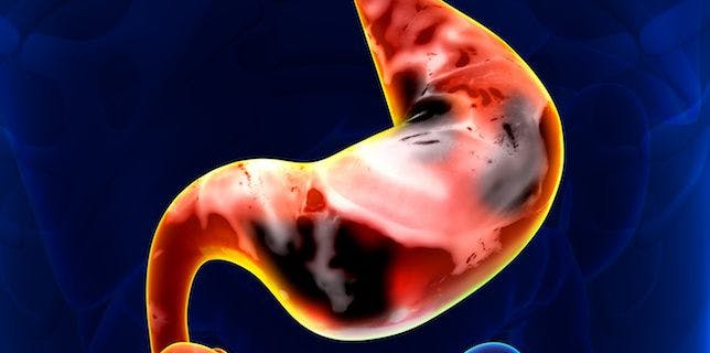 Bemarituzumab, Chemotherapy Show Potential for Treatment of Gastric, Gastroesophageal Junction Cancers
