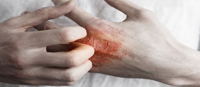 Trending News Today: Patients with Psoriasis May Be at Elevated Risk of Cancer
