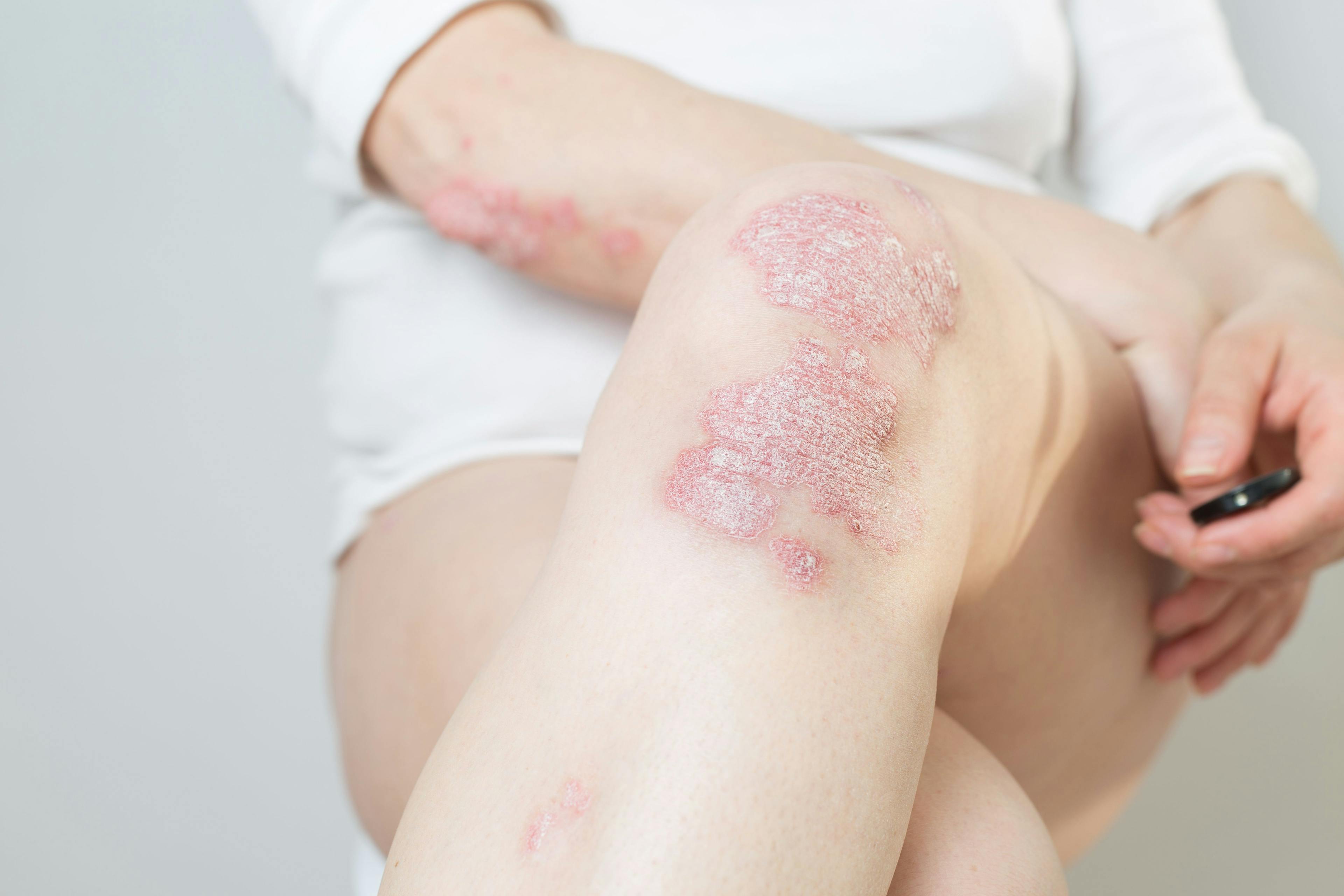 Acute psoriasis on the knees, body, elbows | Image Credit: SNAB - stock.adobe.com
