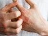 Complex Link Between Atopic Dermatitis With Asthma, Food Allergies