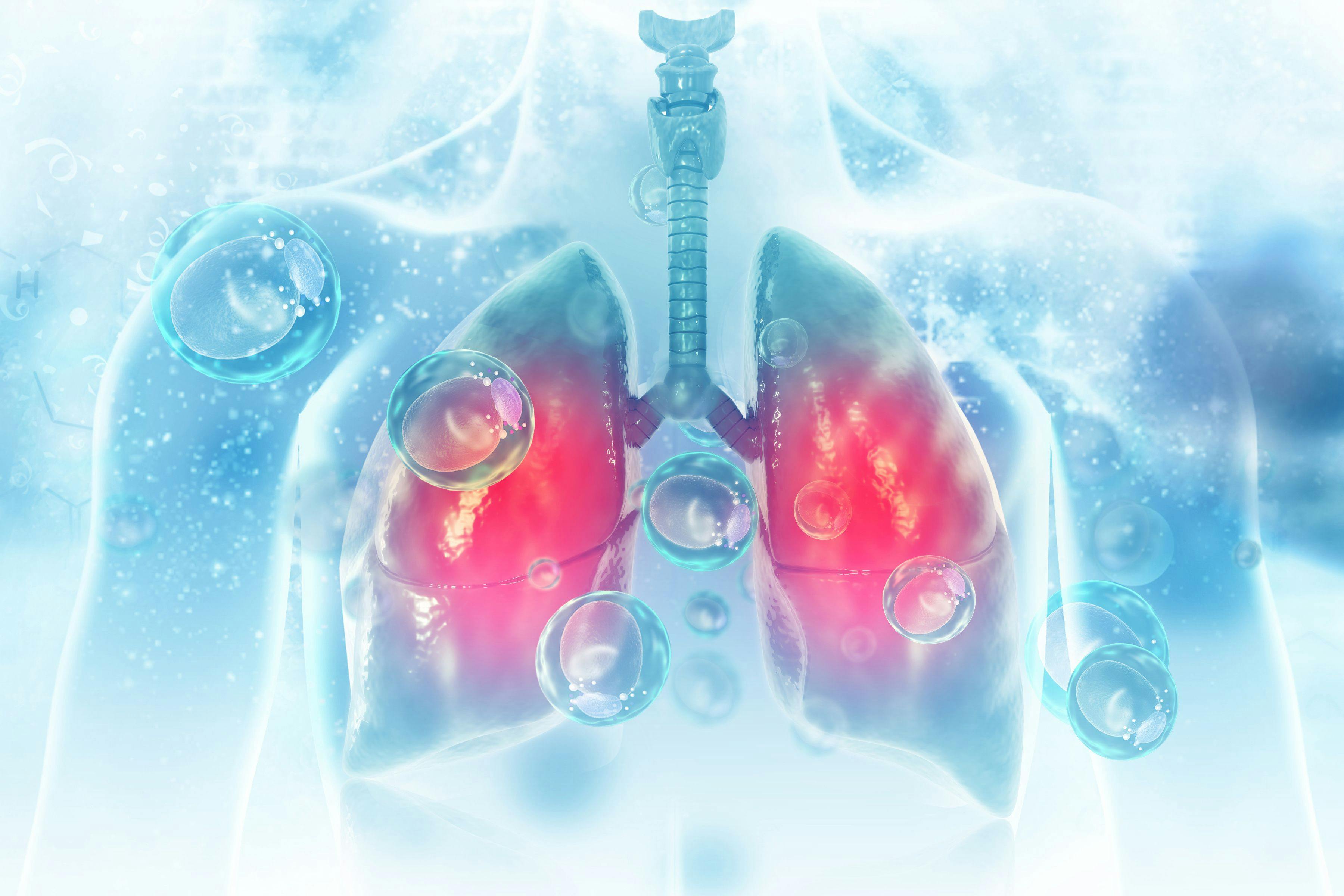 Virus and bacteria infected the Human lungs. lung disease | Image Credit: Crystal light - stock.adobe.com
