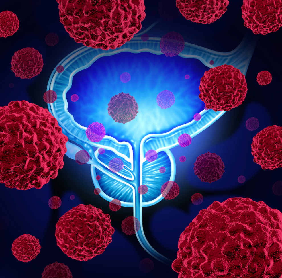 Assessing Germline, Somatic Genetic Testing for Prostate Cancer