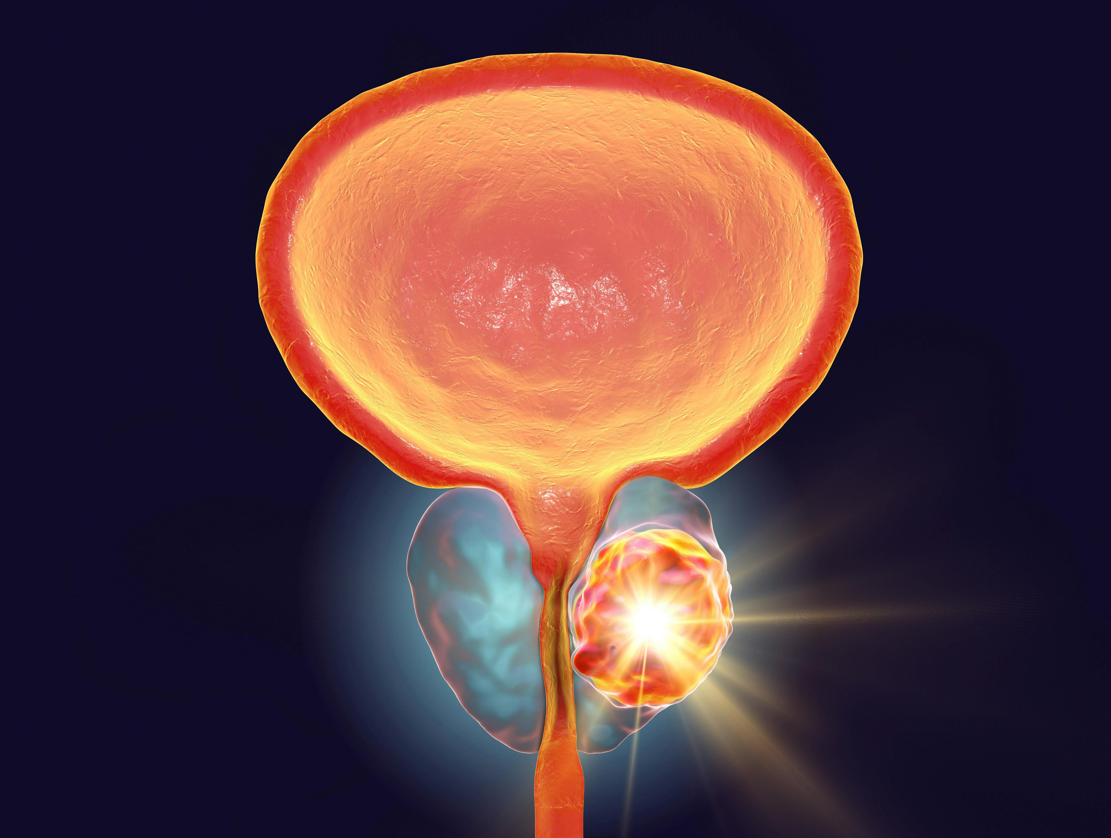 Conceptual image for prostate cancer treatment, 3D illustration showing destruction of a tumor inside prostate gland. Credit: Dr_Microbe - stock.adobe.com