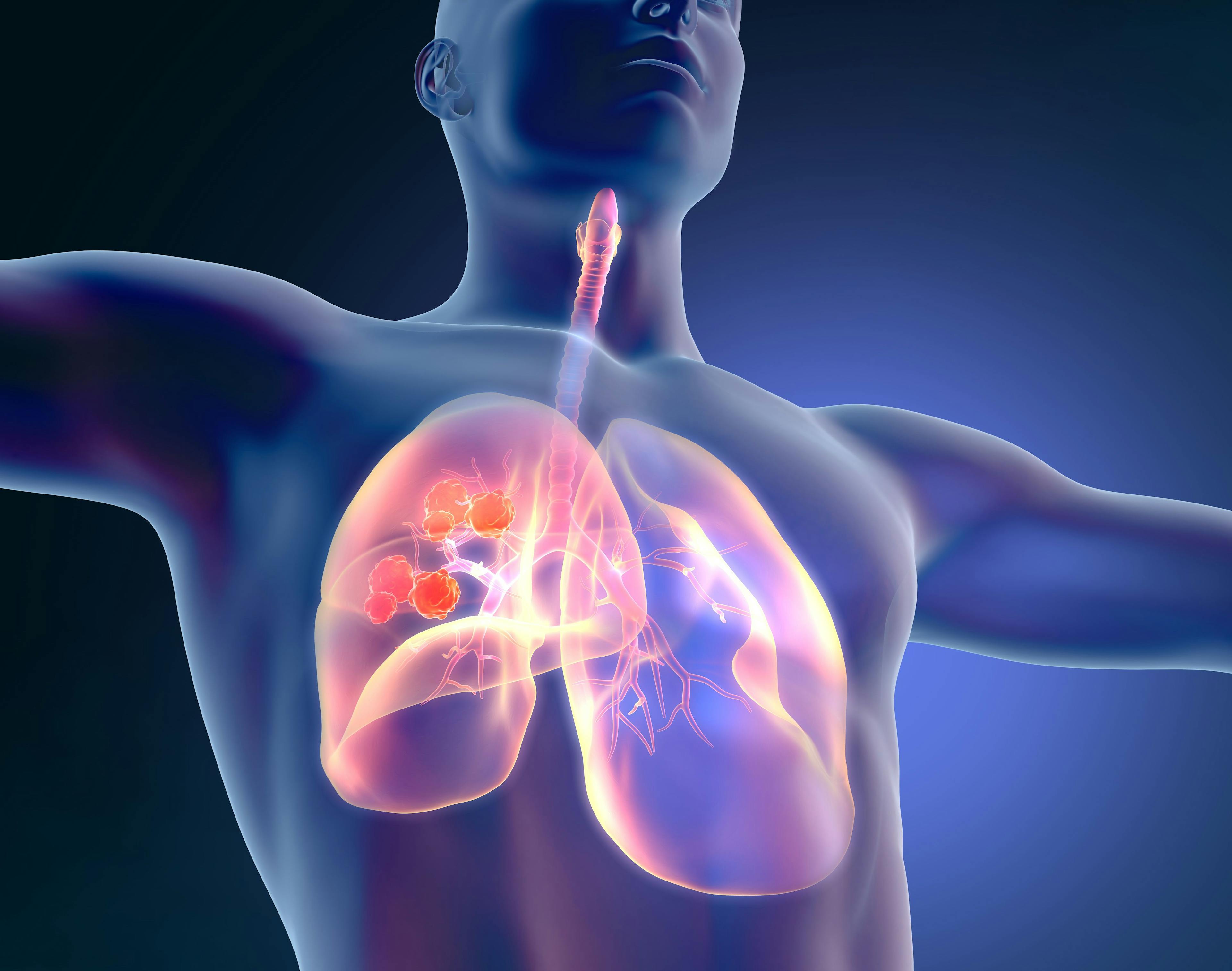 FDA Grants Fast Track Designation for Reqorsa in Combination with Keytruda for NSCLC