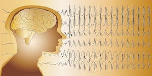 CDC Report: Epilepsy Rates Increasing Among Adults and Children