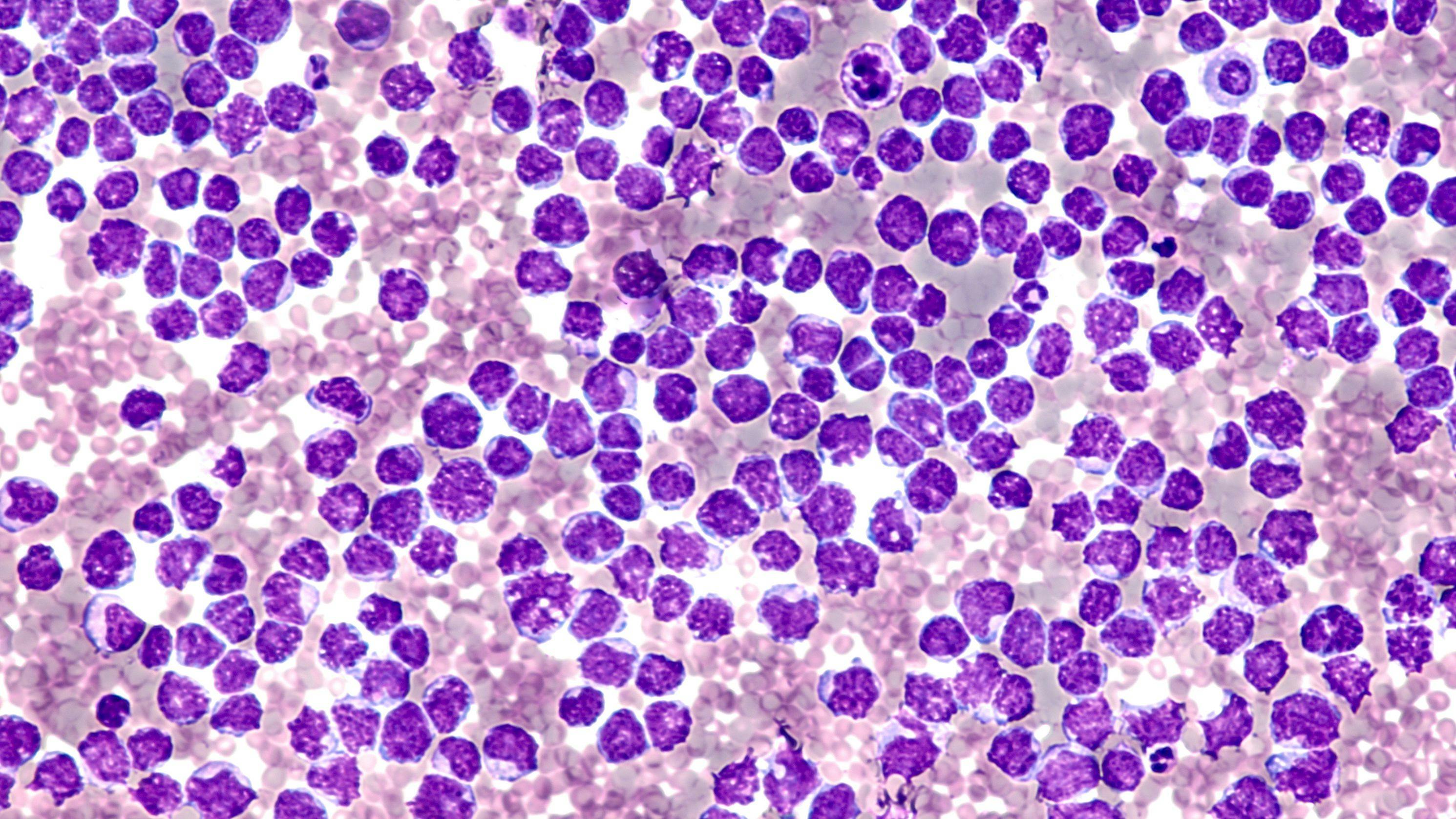 Mantle cell lymphoma -- Image credit: David A Litman | stock.adobe.com