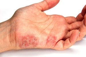 Otezla Shows Long-Term Safety and Efficacy in Psoriatic Arthritis