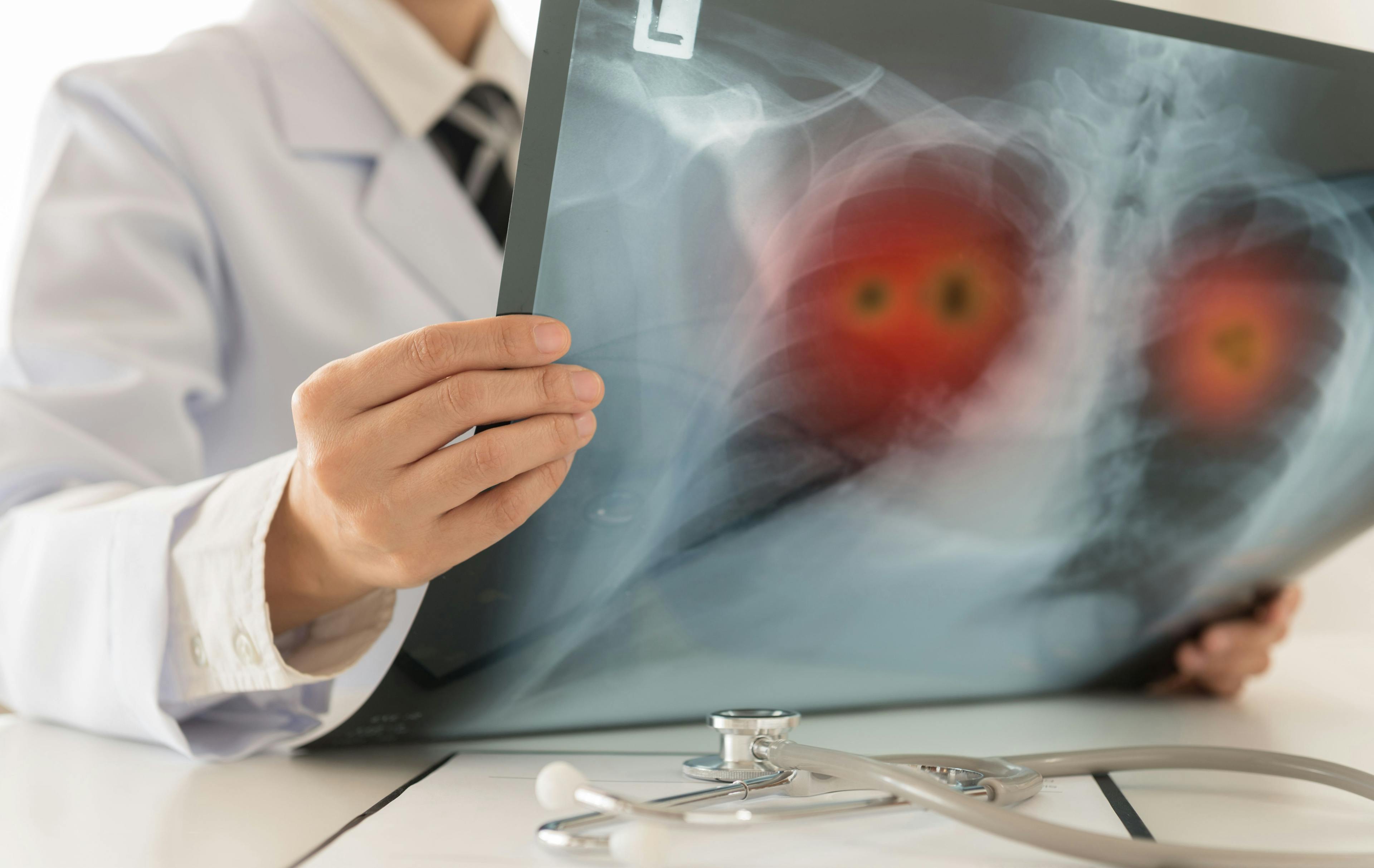 radiology x-ray lung cancer - Image credit: utah51 | stock.adobe.com
