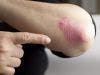 New Psoriatic Arthritis Test Offers Quicker Results
