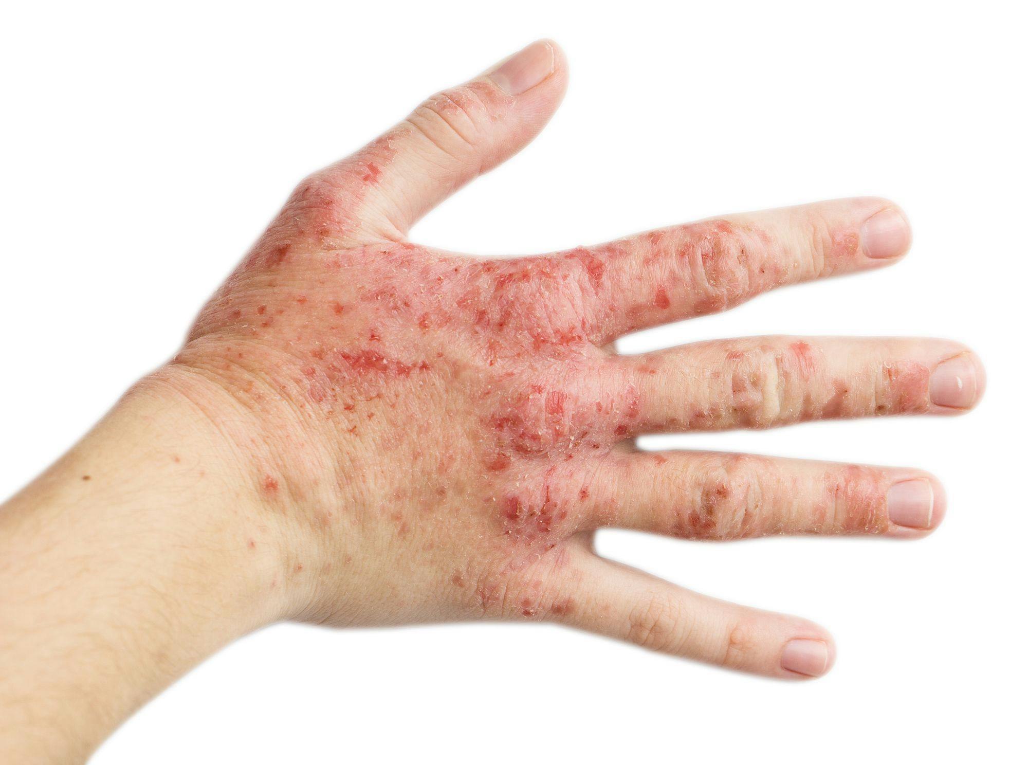 Majority Treated with Lebrikizumab Show Skin Clearance in Lilly's Atopic Dermatitis Studies
