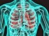 Bacterial Infection Implicated in Development of COPD