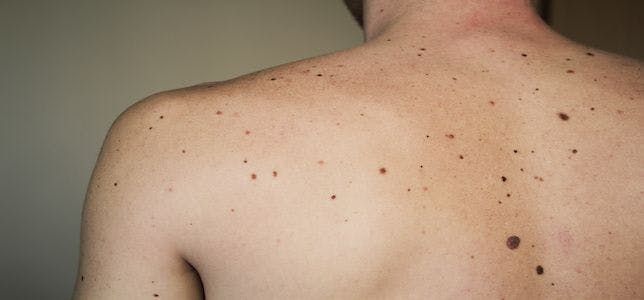 Researchers Find Largest Yearly Declines Ever Recorded in Melanoma Deaths