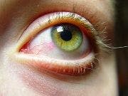 Restasis Multidose Gets FDA Approval for Chronic Dry Eye