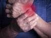 How Rheumatoid Arthritis Affects Patients in the Workplace