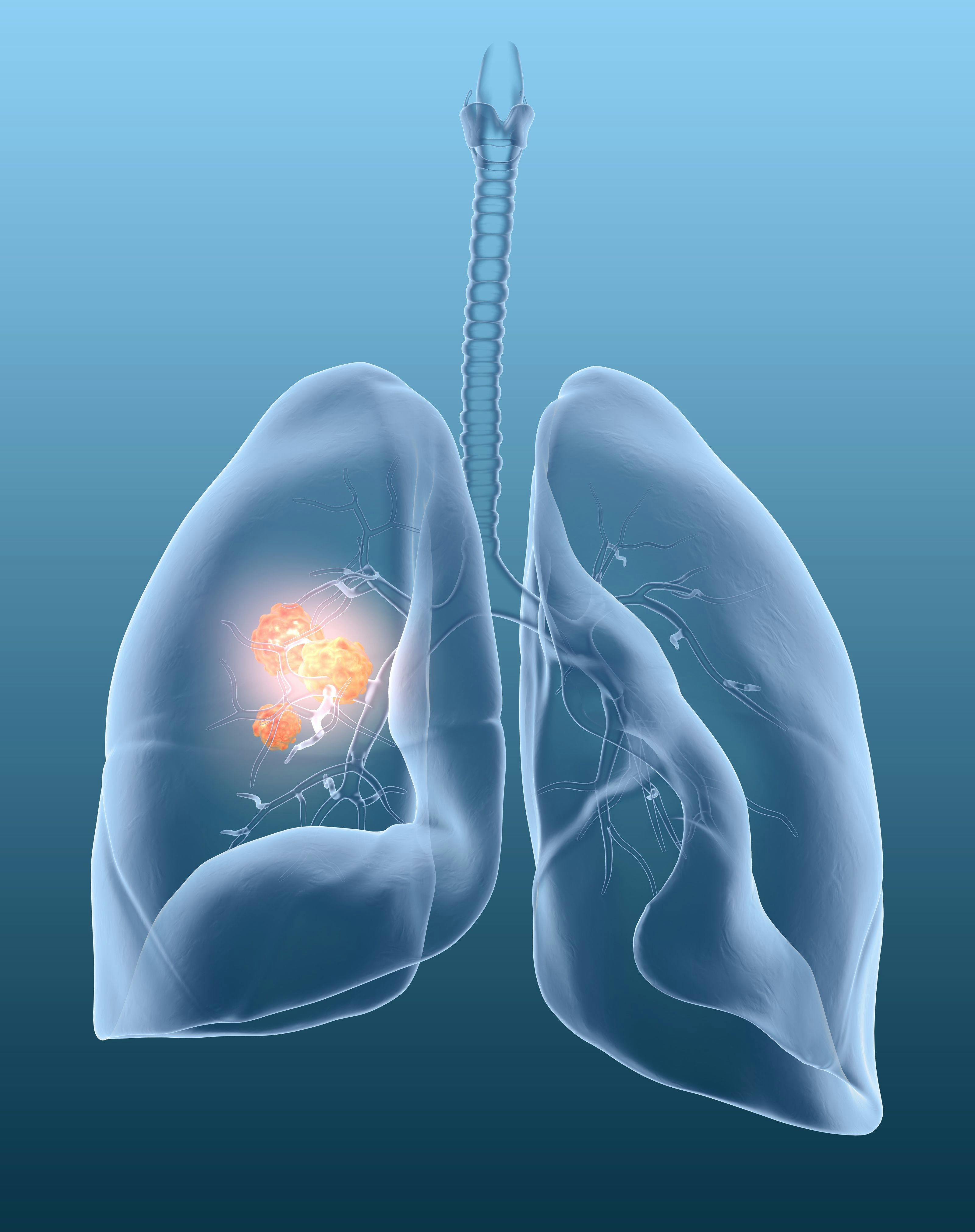 Spectrum Pharmaceuticals Submits New Drug Application for Poziotinib for NSCLC