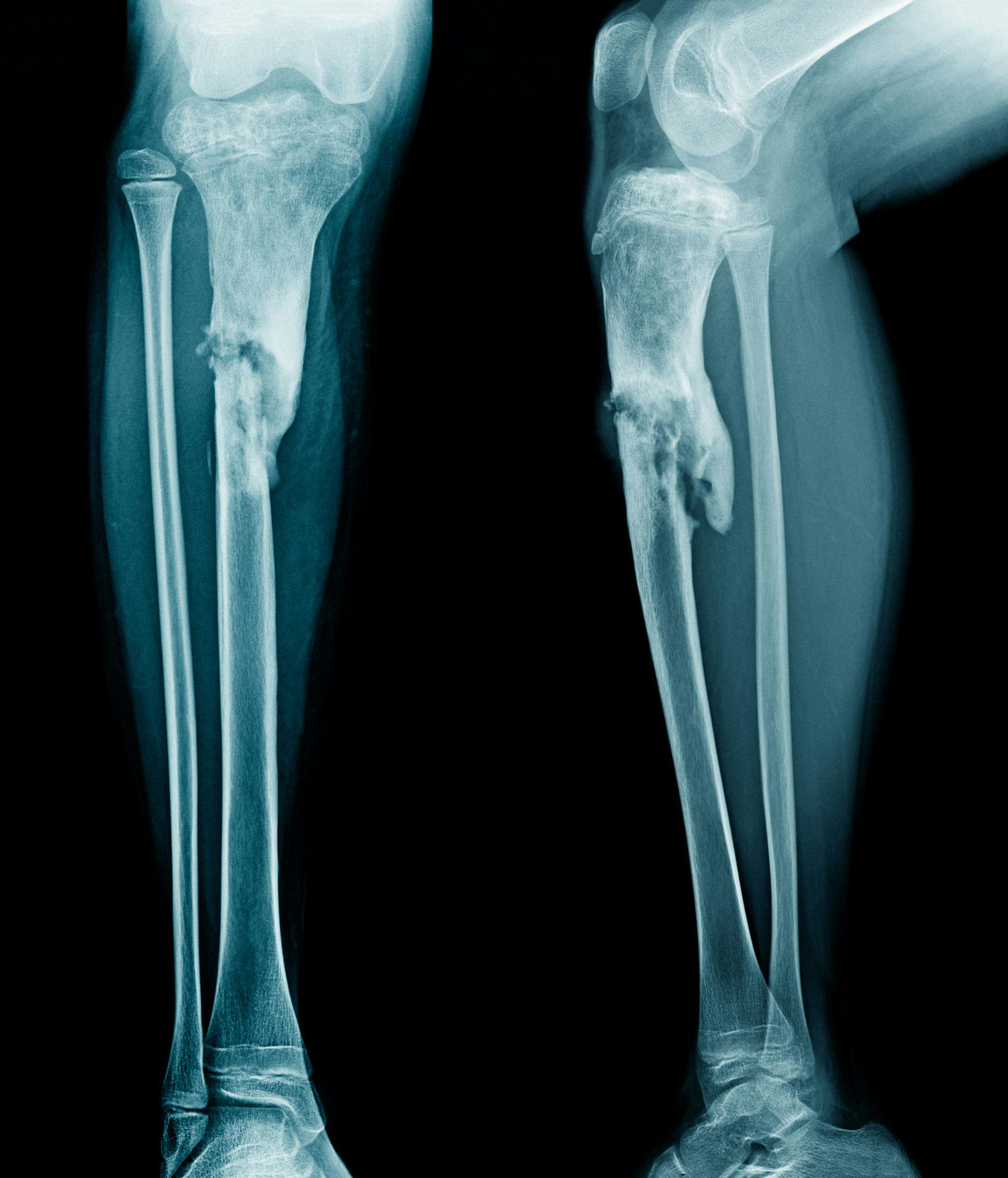 Maintain Bone Health to Prevent Osteoporosis