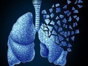 Study: Targeted Therapies Have Boosted Stage 4 Lung Cancer Survival Rates
