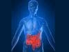 Biologic Drug Approved for Crohn's Disease