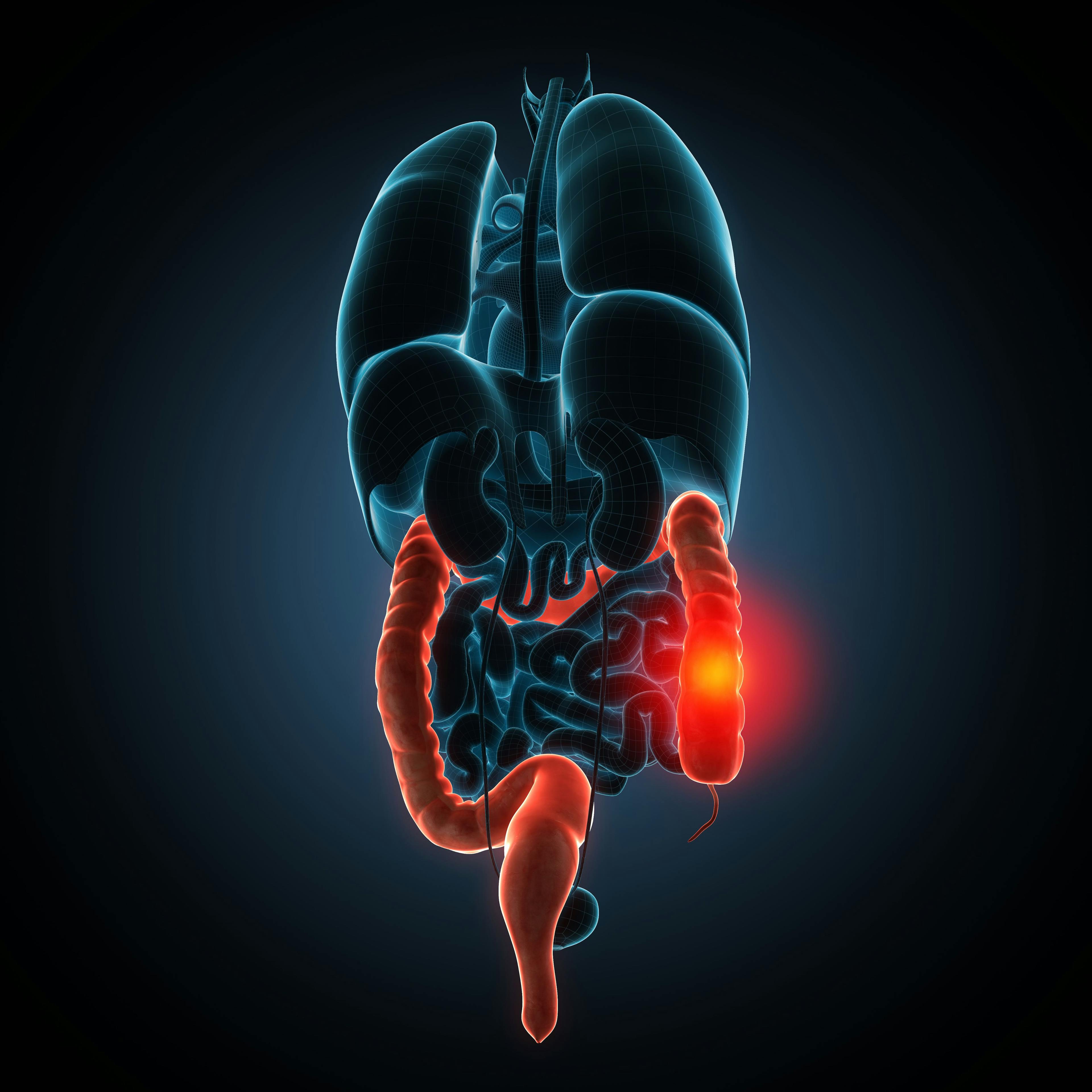 Phase 2 Study Indicates Mirikizumab Induces Mucosal Healing in Patients With Ulcerative Colitis