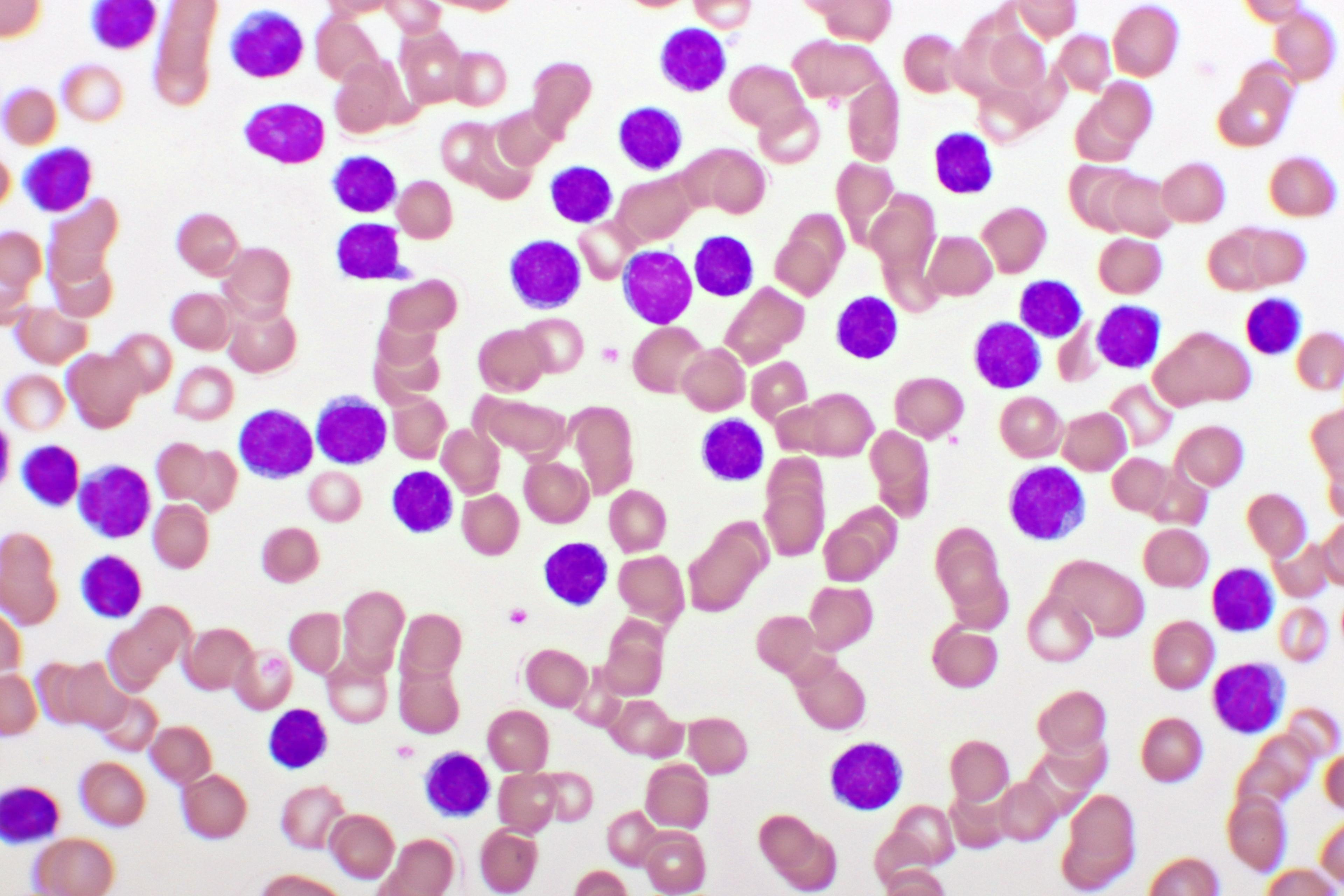 Microscopic blood picture of CLL -- Image credit: jarun011 | stock.adobe.com