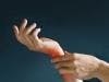 Tenosynovitis May Predict Rheumatoid Arthritis