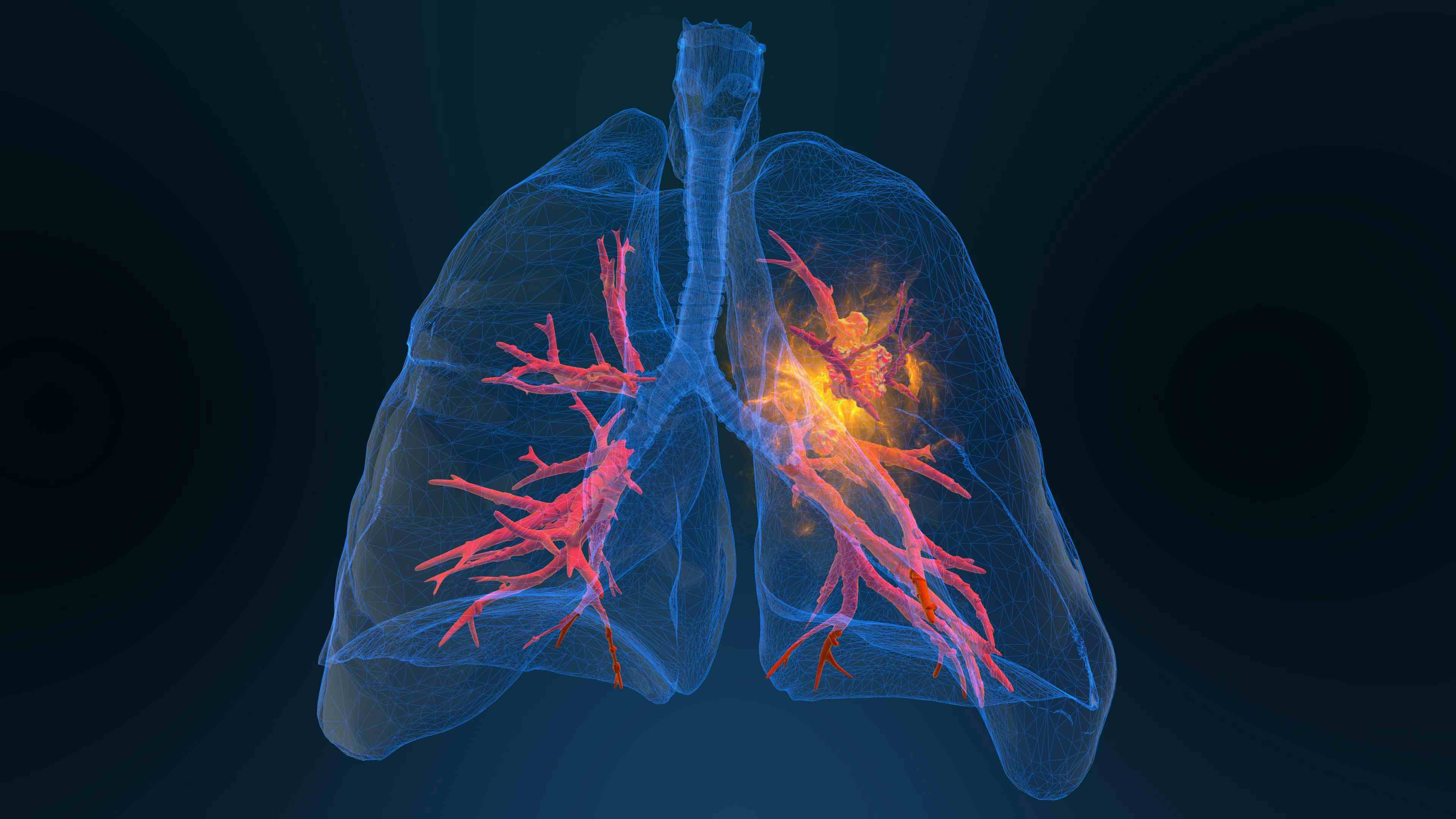 3d rendered illustration of lung cancer 3D illustration - Image credit:  appledesign | stock.adobe.com