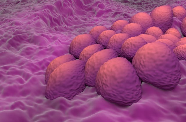 Endometrial cancer cells in the uterus or cervix | Image Credit: LASZLO - stock.adobe.com