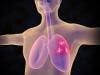Molecule Triggers Cell Death in Non-Small Cell Lung Cancer