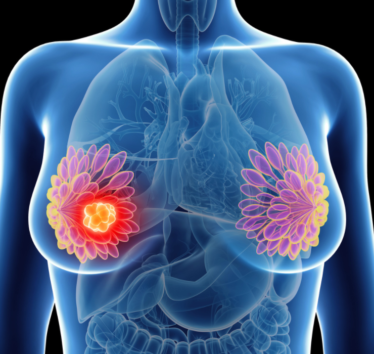 Men With Stage IV Breast Cancer Benefit from Trimodal Therapy