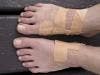 Graft Device Now Approved for Diabetic Foot Ulcers