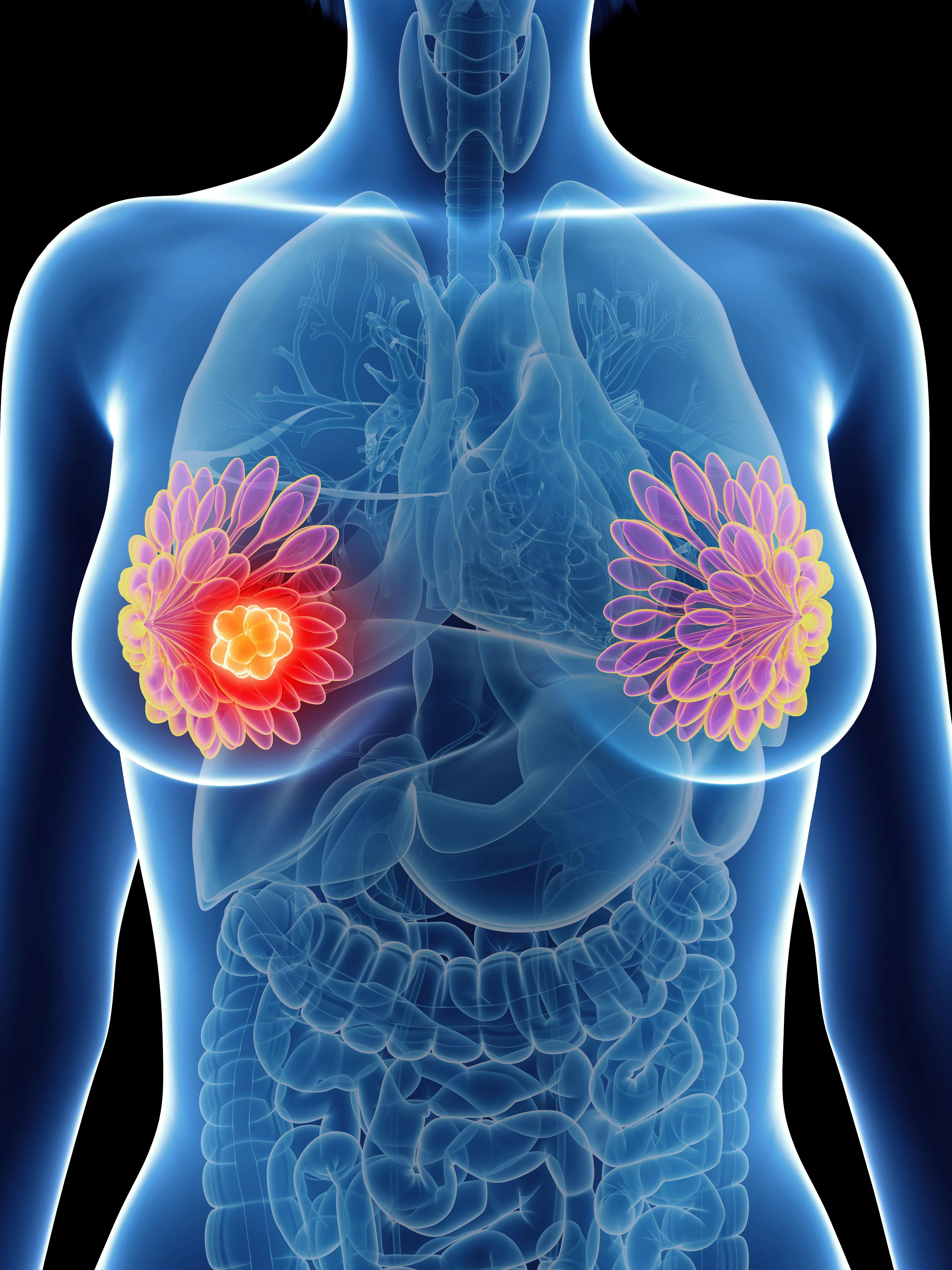 Study Results Show Early Benefit of Trodelvy as Therapy for Triple-Negative Breast Cancer 