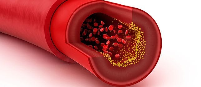 New Class of Medications Lowers Cholesterol