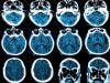 Brain Scans Can Detect Multiple Sclerosis Risk in Pediatric Patients